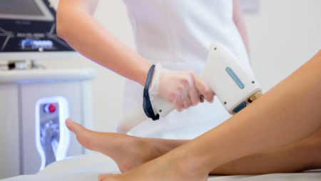 Laser hair removal